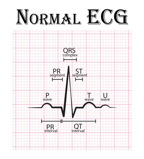 normal ecg sample|what does a normal ecg look like.